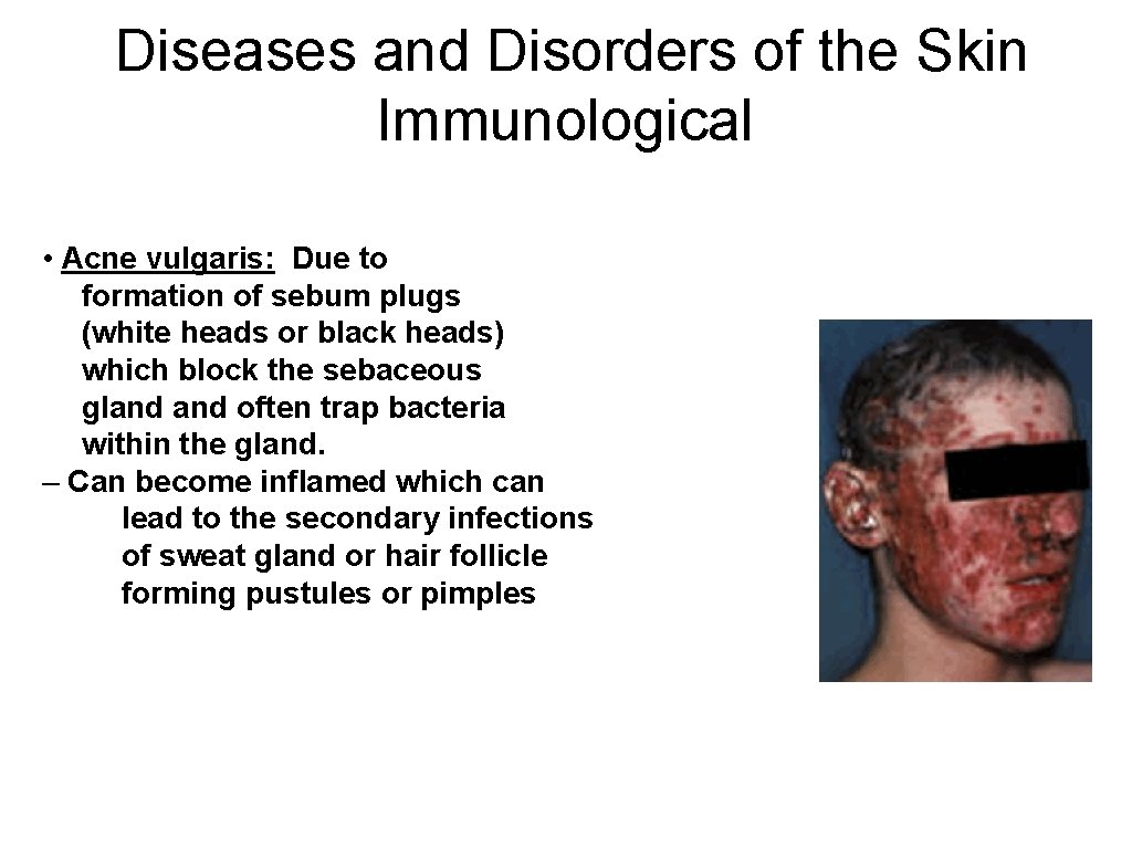 Diseases and Disorders of the Skin Immunological • Acne vulgaris: Due to formation of