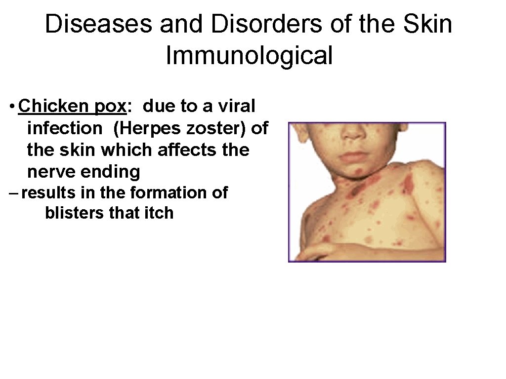 Diseases and Disorders of the Skin Immunological • Chicken pox: due to a viral