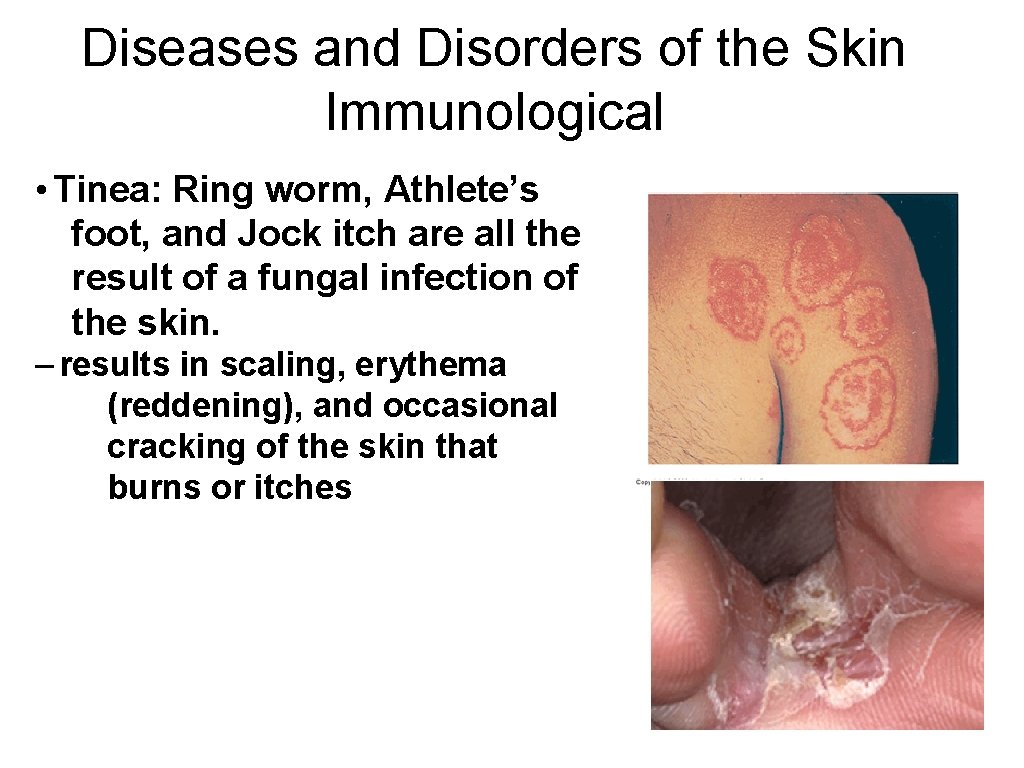 Diseases and Disorders of the Skin Immunological • Tinea: Ring worm, Athlete’s foot, and