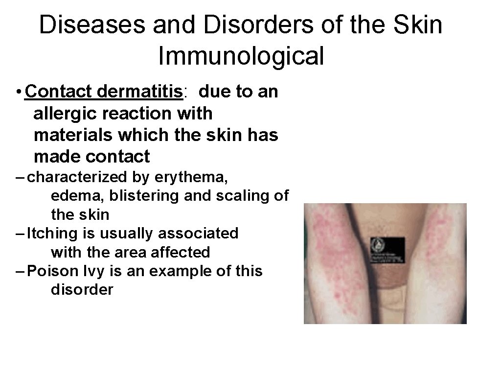 Diseases and Disorders of the Skin Immunological • Contact dermatitis: due to an allergic