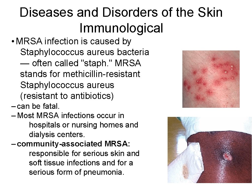 Diseases and Disorders of the Skin Immunological • MRSA infection is caused by Staphylococcus