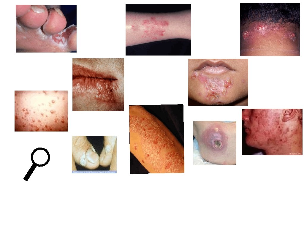 Athlete's foot Dermatitis Boil Impetigo Chicken pox Herpes Warts Psoriasis MRSA (boil) Acne 