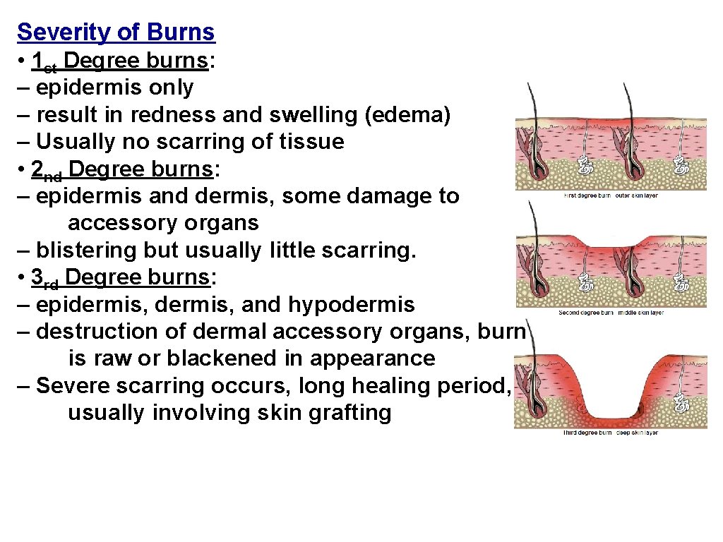 Severity of Burns • 1 st Degree burns: – epidermis only – result in