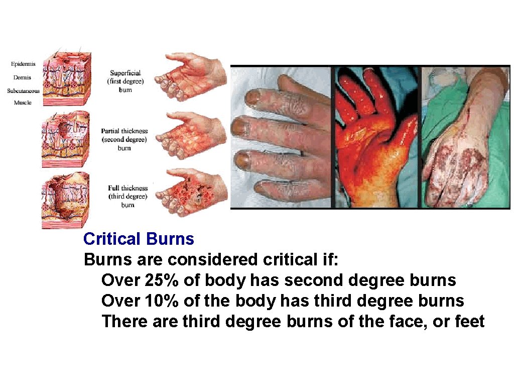 Critical Burns are considered critical if: Over 25% of body has second degree burns