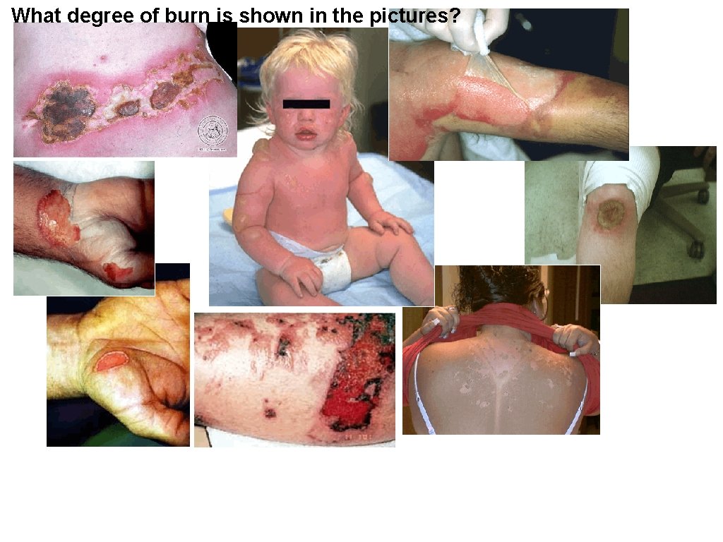 What degree of burn is shown in the pictures? 