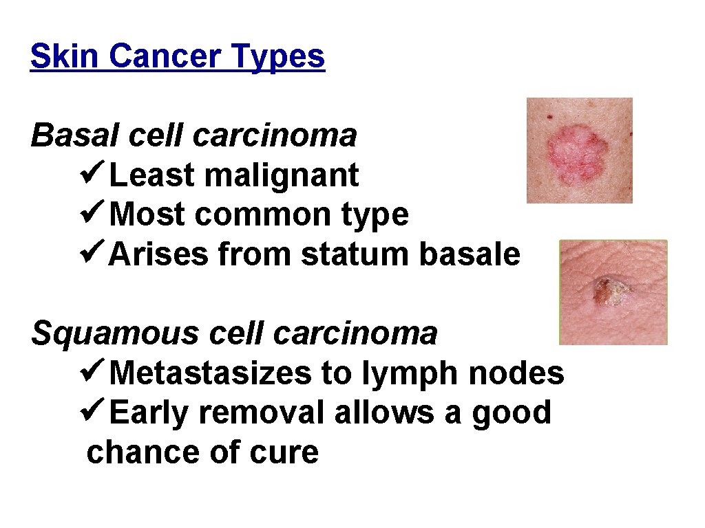 Skin Cancer Types Basal cell carcinoma ü Least malignant ü Most common type ü