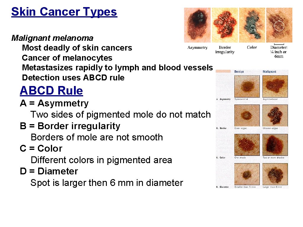 Skin Cancer Types Malignant melanoma Most deadly of skin cancers Cancer of melanocytes Metastasizes