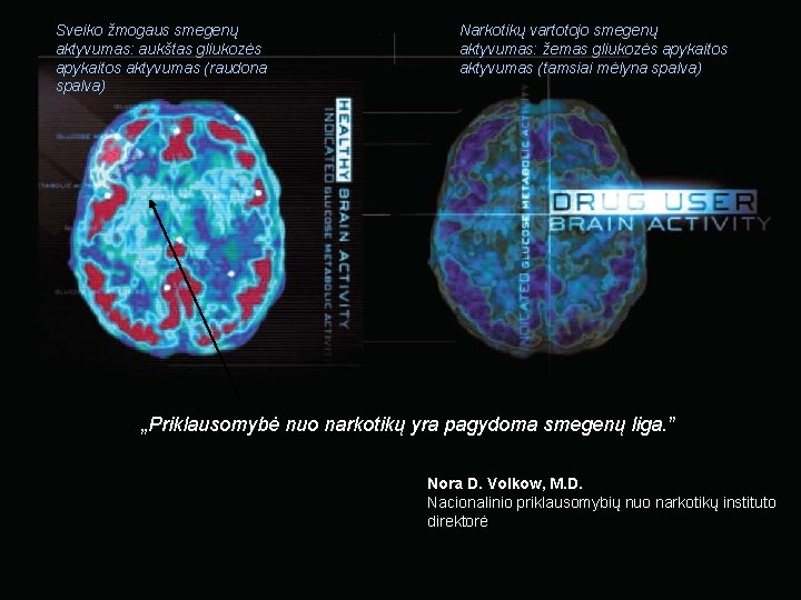 Sveiko žmogaus smegenų aktyvumas: aukštas gliukozės apykaitos aktyvumas (raudona spalva) Narkotikų vartotojo smegenų aktyvumas: