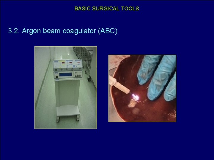 BASIC SURGICAL TOOLS 3. 2. Argon beam coagulator (ABC) 