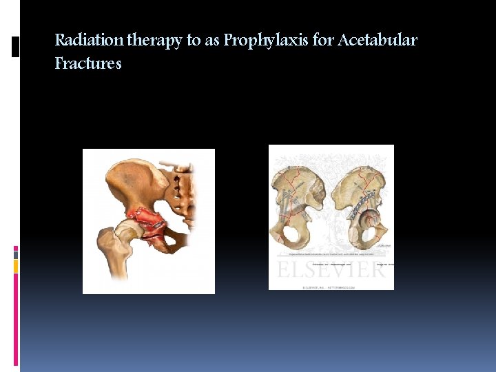 Radiation Therapy as Prophylaxis for HETEROTOPIC OSSIFICATIONS BY