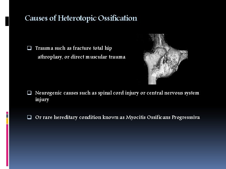 Causes of Heterotopic Ossification q Trauma such as fracture total hip athroplasy, or direct