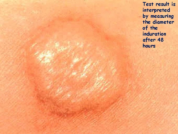 Test result is interpreted by measuring the diameter of the induration after 48 hours