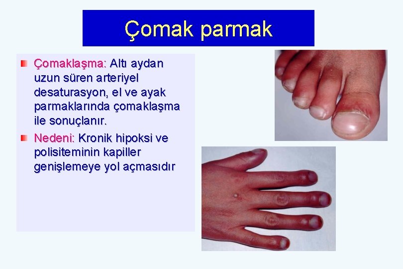 Çomak parmak Çomaklaşma: Altı aydan uzun süren arteriyel desaturasyon, el ve ayak parmaklarında çomaklaşma