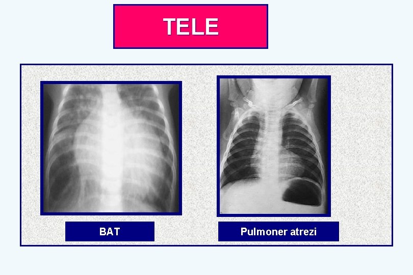 TELE BAT Pulmoner atrezi 