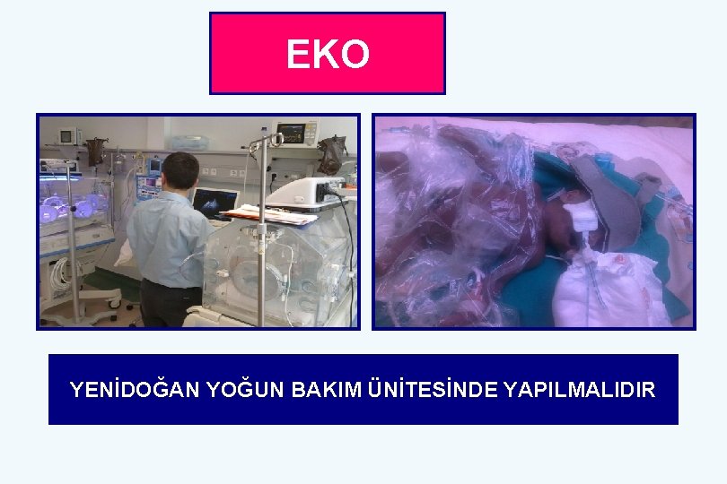 EKO YENİDOĞAN YOĞUN BAKIM ÜNİTESİNDE YAPILMALIDIR 