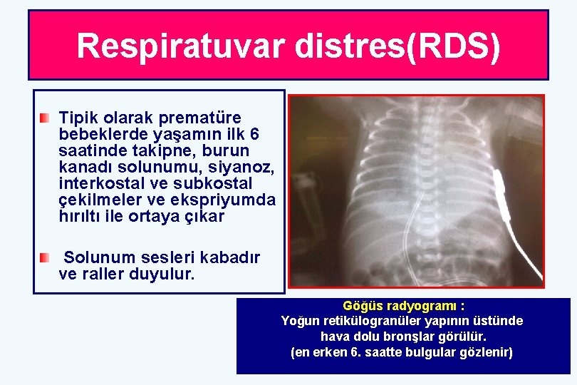 Respiratuvar distres(RDS) Tipik olarak prematüre bebeklerde yaşamın ilk 6 saatinde takipne, burun kanadı solunumu,