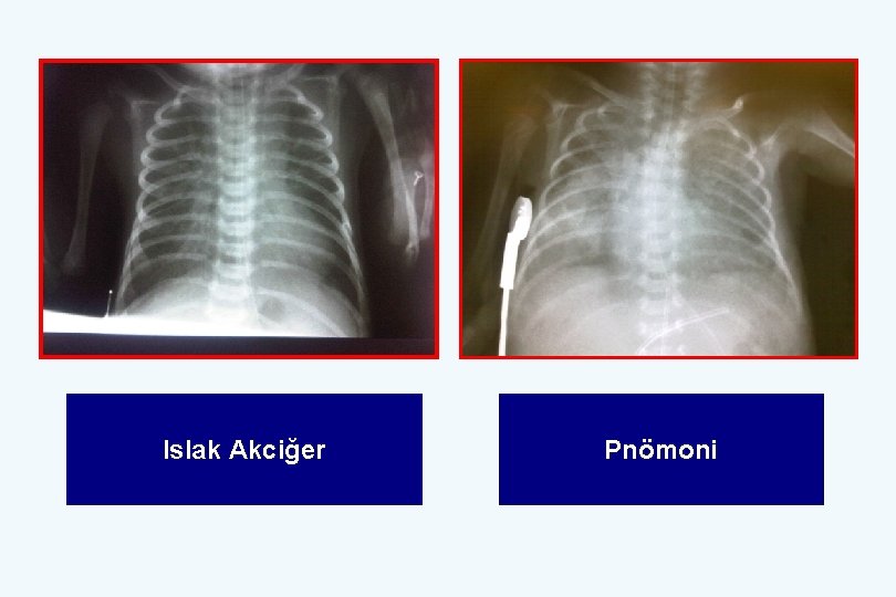 Islak Akciğer Pnömoni 
