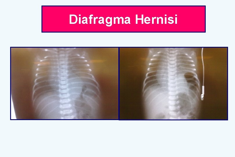 Diafragma Hernisi 