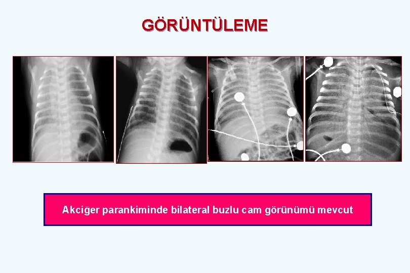 GÖRÜNTÜLEME Akciğer parankiminde bilateral buzlu cam görünümü mevcut 