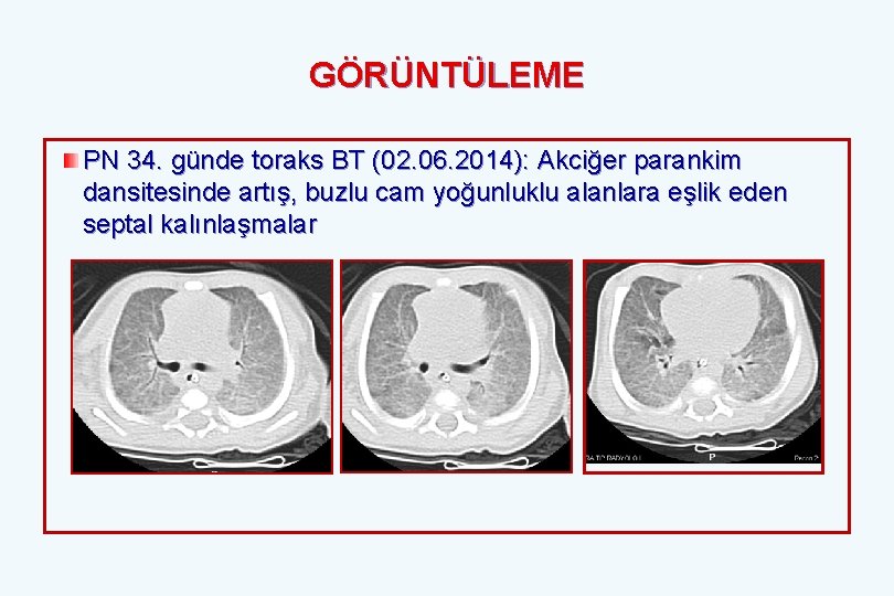 GÖRÜNTÜLEME PN 34. günde toraks BT (02. 06. 2014): Akciğer parankim dansitesinde artış, buzlu