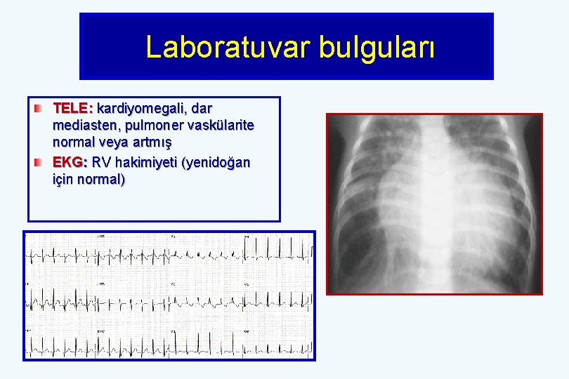  Laboratuvar bulguları TELE: kardiyomegali, dar mediasten, pulmoner vaskülarite normal veya artmış EKG: RV