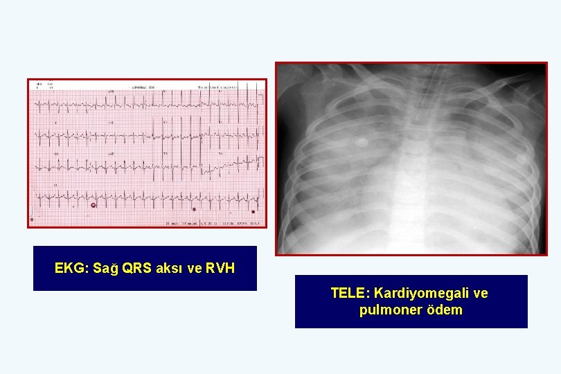 EKG: Sağ QRS aksı ve RVH TELE: Kardiyomegali ve pulmoner ödem 