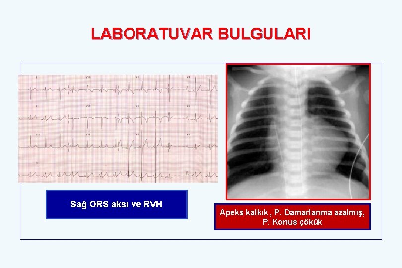 LABORATUVAR BULGULARI Sağ ORS aksı ve RVH Apeks kalkık , P. Damarlanma azalmış, P.