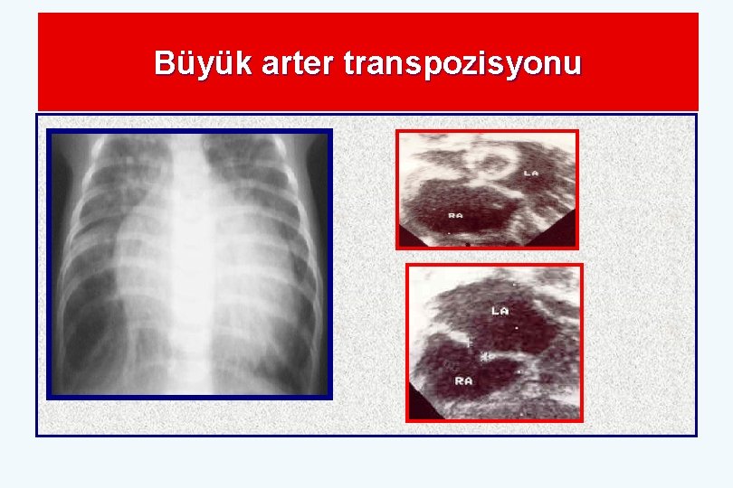 Büyük arter transpozisyonu 