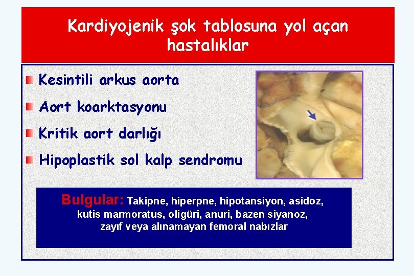 Kardiyojenik şok tablosuna yol açan hastalıklar Kesintili arkus aorta Aort koarktasyonu Kritik aort darlığı