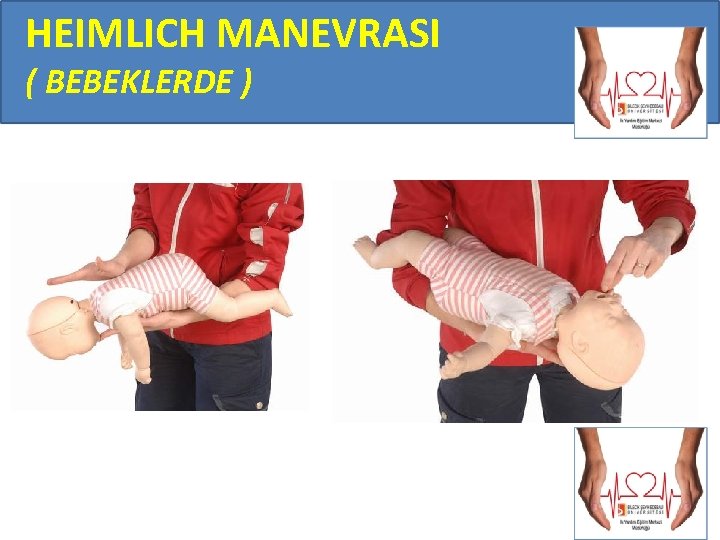 HEIMLICH MANEVRASI ( BEBEKLERDE ) 