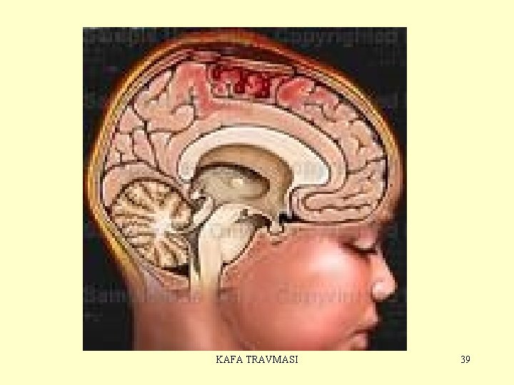 KAFA TRAVMASI 39 