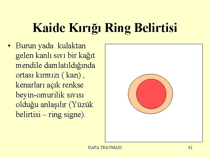 Kaide Kırığı Ring Belirtisi • Burun yada kulaktan gelen kanlı sıvı bir kağıt mendile