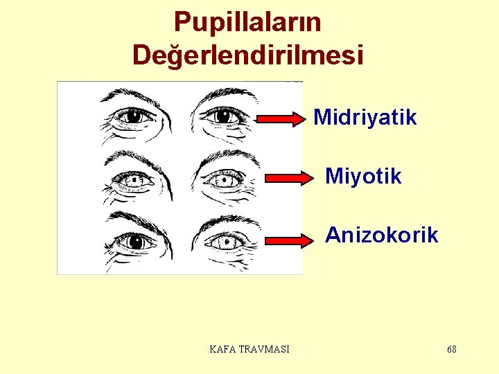 Pupillaların Değerlendirilmesi Midriyatik Miyotik Anizokorik KAFA TRAVMASI 68 