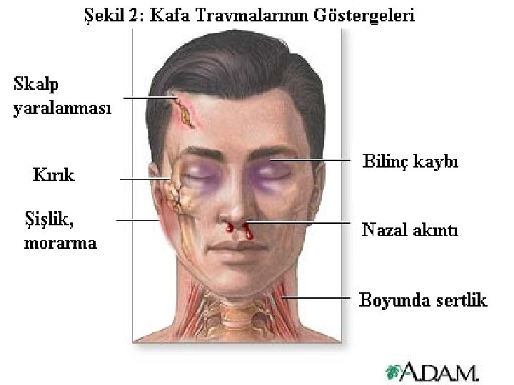 KAFA TRAVMASI 76 