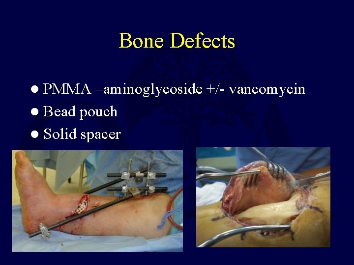 Bone Defects l PMMA –aminoglycoside +/- vancomycin l Bead pouch l Solid spacer Bone Defects l PMMA –aminoglycoside +/- vancomycin l Bead pouch l Solid spacer