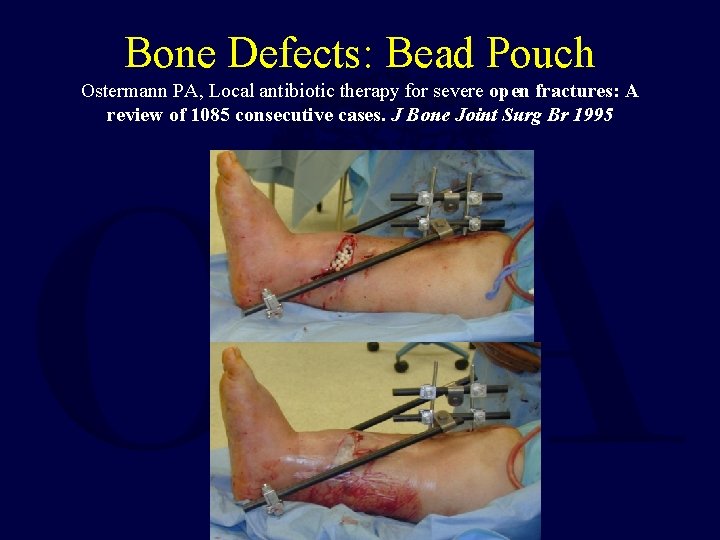 Bone Defects: Bead Pouch Ostermann PA, Local antibiotic therapy for severe open fractures: A