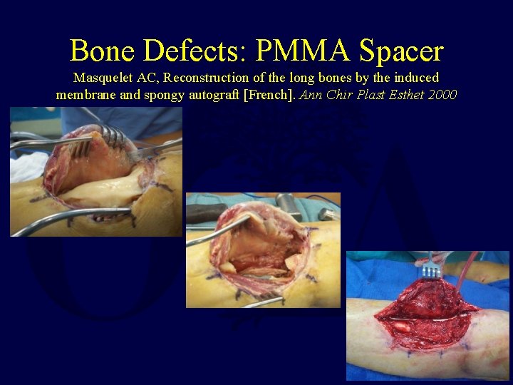 Bone Defects: PMMA Spacer Masquelet AC, Reconstruction of the long bones by the induced