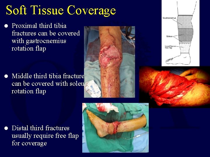 Soft Tissue Coverage l Proximal third tibia fractures can be covered with gastrocnemius rotation