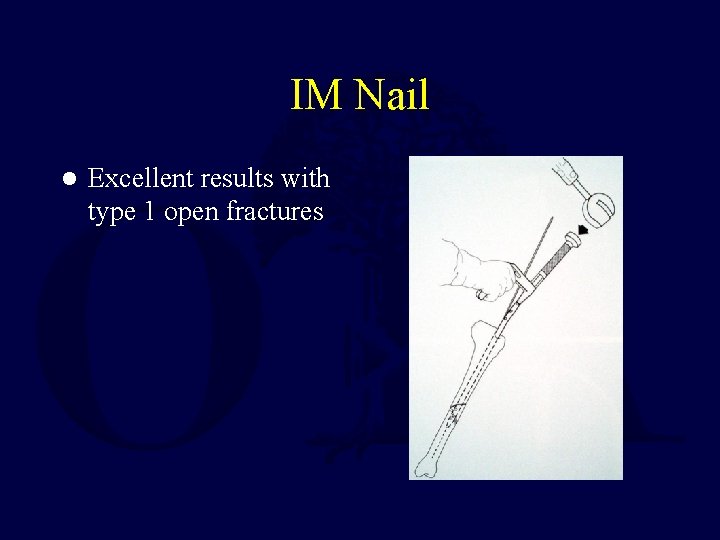 IM Nail l Excellent results with type 1 open fractures 