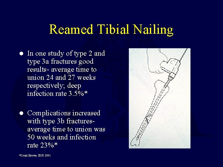 Reamed Tibial Nailing l In one study of type 2 and type 3 a
