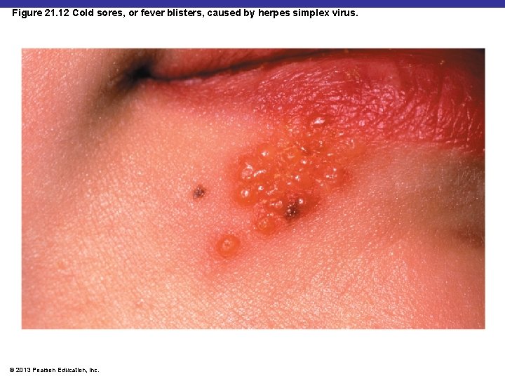 Figure 21. 12 Cold sores, or fever blisters, caused by herpes simplex virus. ©