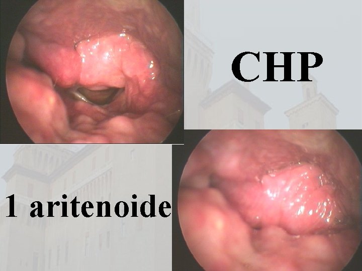 CHP 1 aritenoide 