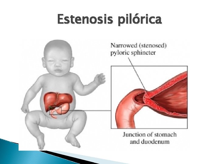 Estenosis pilórica Estenosis pilórica