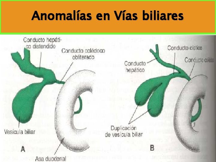 Anomalías en Vías biliares Anomalías en Vías biliares