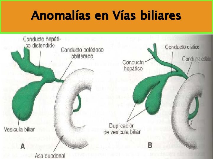 Anomalías en Vías biliares 