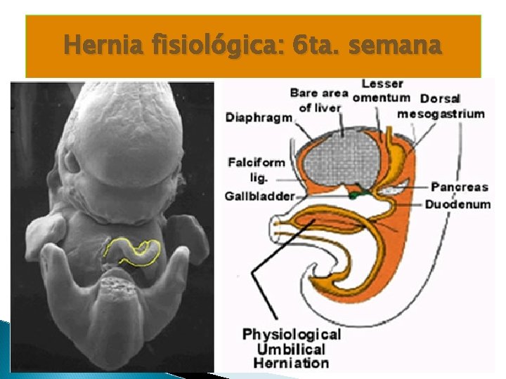 Hernia fisiológica: 6 ta. semana Hernia fisiológica: 6 ta. semana