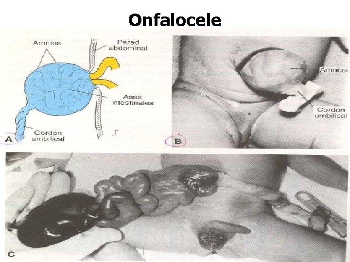 Onfalocele 