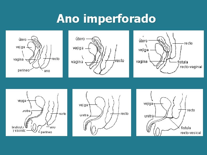 Ano imperforado Ano imperforado