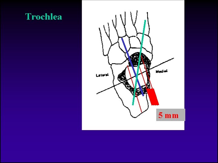 Trochlea 5 mm 