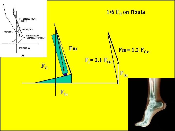 1/6 FC on fibula Fm Fm= 1. 2 FGr Fr= 2. 1 FGr FGr